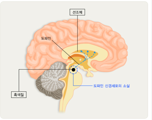 파킨슨병 초기 치료의 중요성