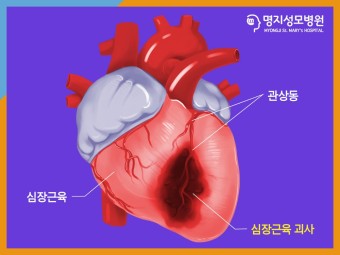 심근경색 초기증상