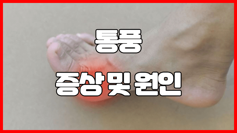  통풍 증상 및 원인 : 나쁜 음식, 좋은 음식