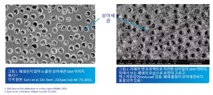 플루오르화석-상아세관-폐쇄효과-주사전자현미경