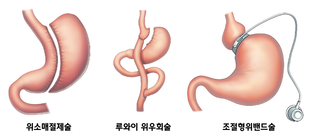 대표적인 비만수술의 종류 (출처:비만대사외과학 교과서)