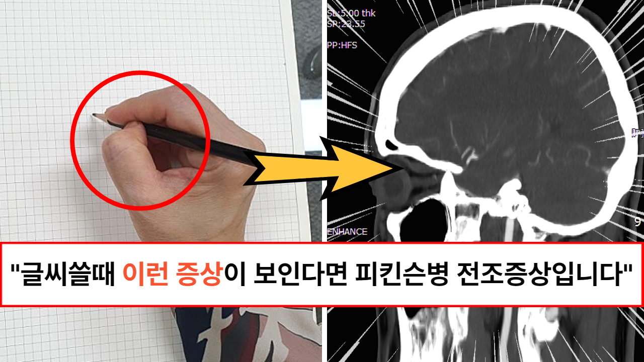 “손이 자주 떨리는 분들은 꼭 병원가야 합니다”  수전증과 혼동되기 쉬워 초기 단계에서 말기로 넘어가는 파킨슨병 대표적인 전조증상