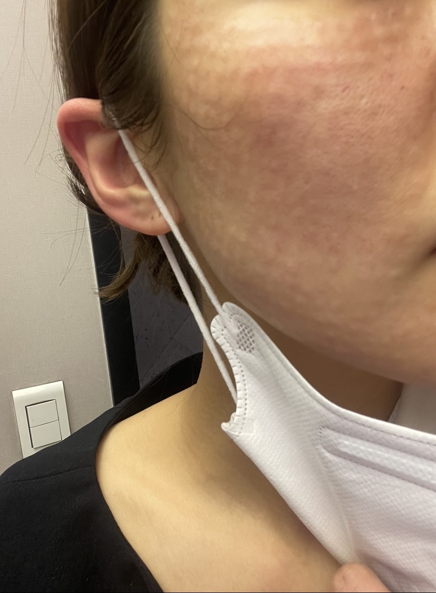 코조각주사 콧볼축소 효과