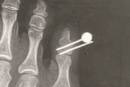 새끼발가락 골절 철심 수술