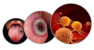 The Most Fatal Oral Cancer, Tongue Cancer: Preventable with Lifestyle Habits.
