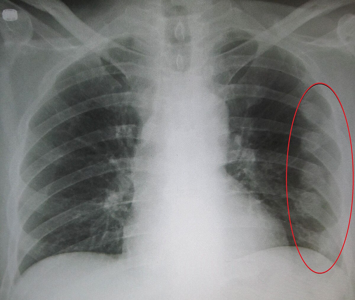 갈비뼈 금이갔을때빨리낫는법(rib fracture treatment)