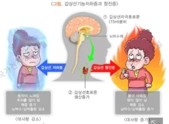 갑상샘 저하증 갑상선 기능저하증 증상 수치 치료_12
