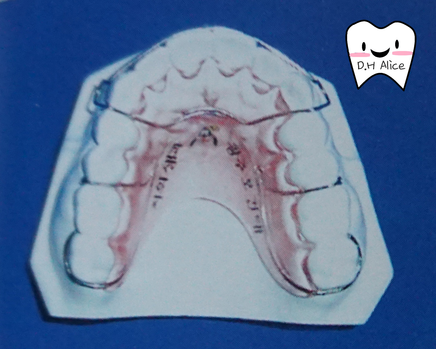 교정 유지 장치는 치약으로 닦으면 왜 안되는 거죠?-치위생사가 알려주는 교정 교정 유지 장치는 치약으로 닦으면 왜 안되는 거죠?-치위생사가 알려주는 교정