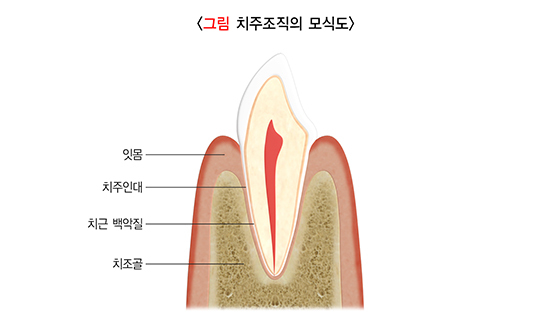  잇몸병