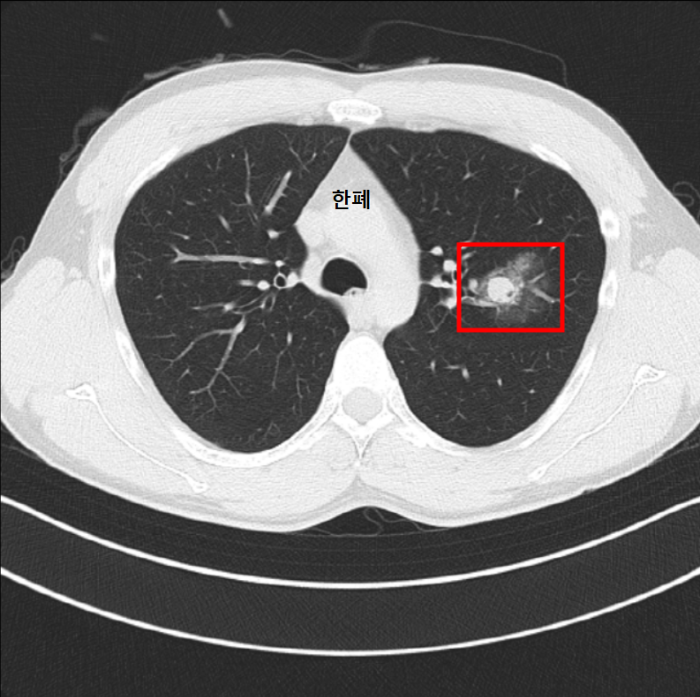 폐결절 CT 사진