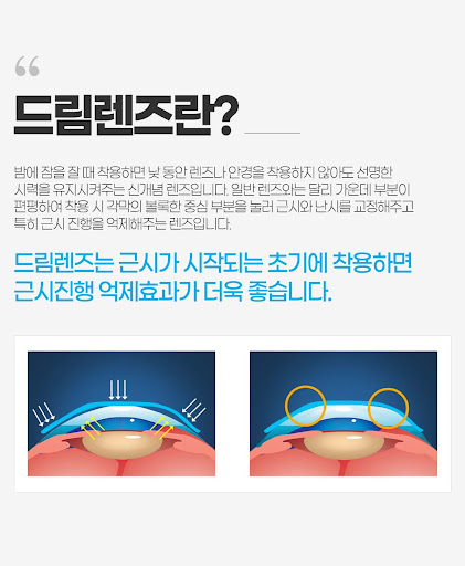  "드림렌즈, 정말 꿈같은 시력 교정법일까? 부작용은 없을까?"