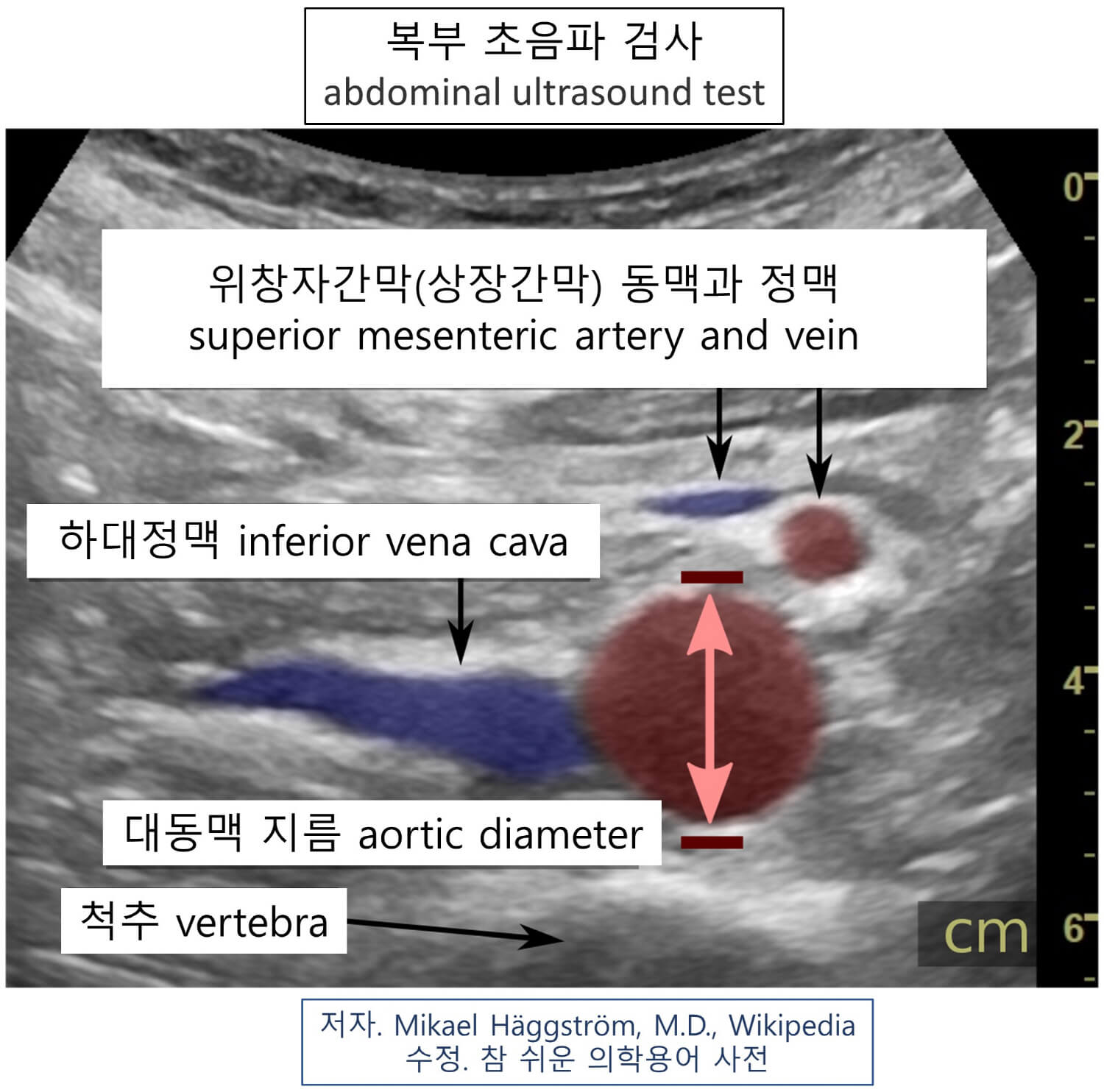 의학용어 abdominal ultrasound test 뜻 복부 초음파 검사