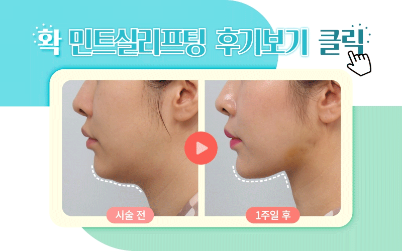  민트실리프팅가격 턱선리프팅 가보자고! (파인/이지4줄)