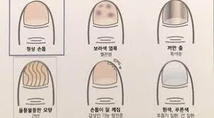 손톱으로 보는 건강상태