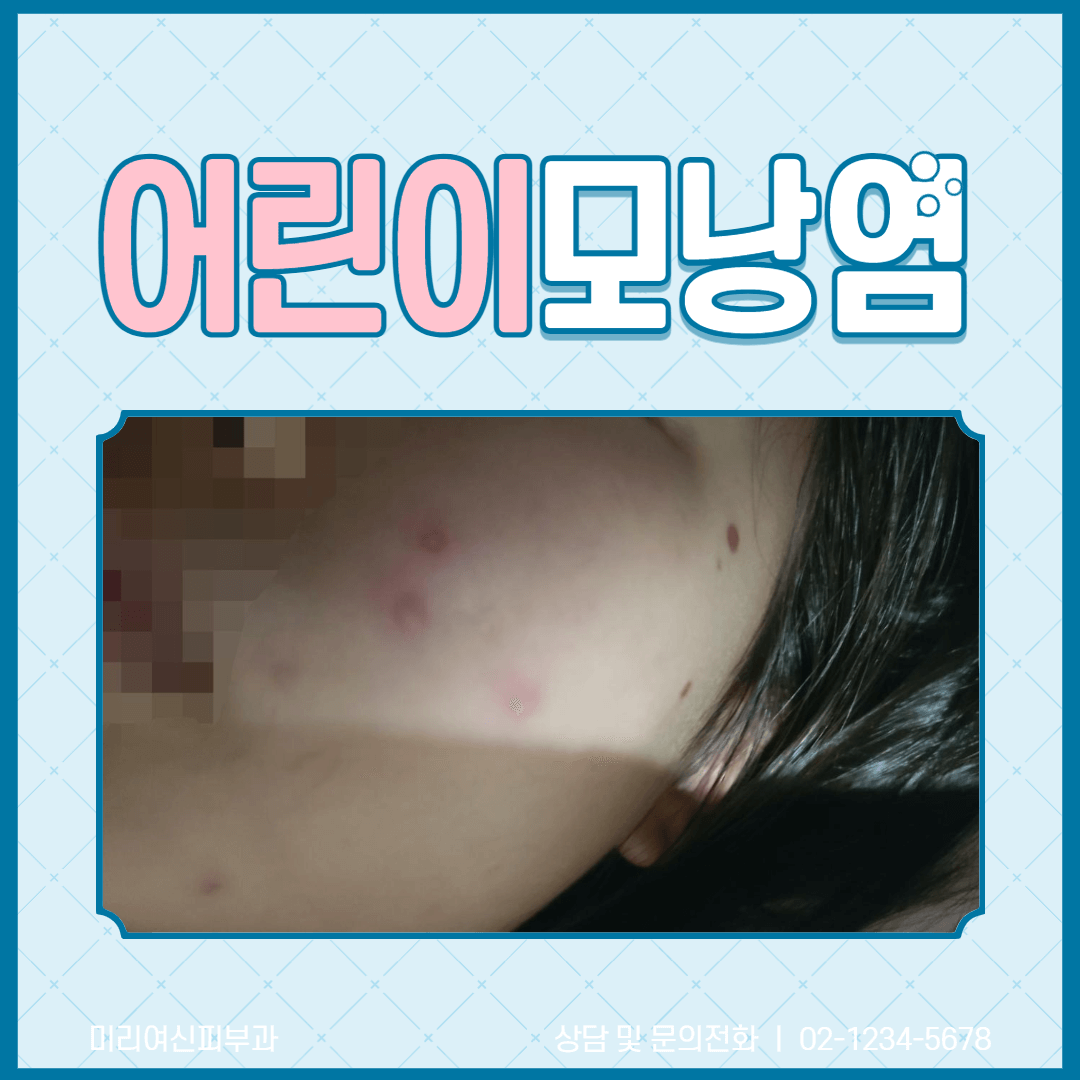  초등학생 어린이 모낭염 걸린 사연 - 증상과 치료방법