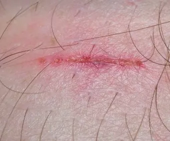 흉터전용 치료 추천 스카덤 겔 효능효과_27