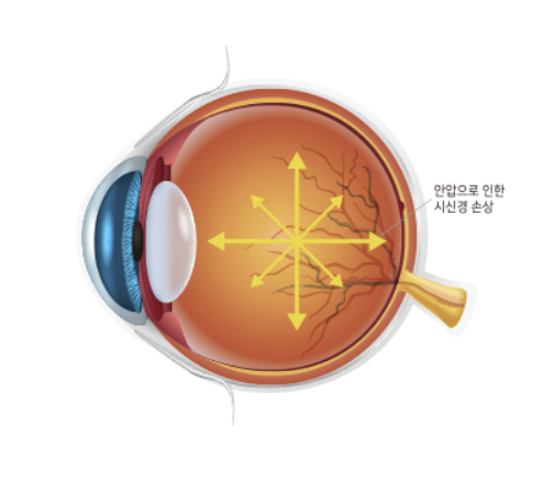 안압 높을때 시신경 손상
