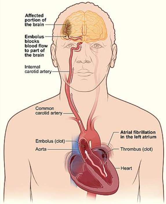 심방세동 부정맥