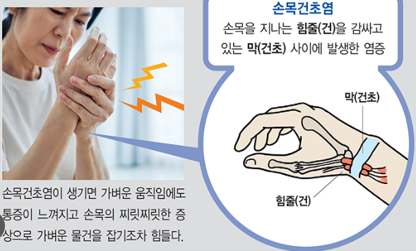 건초염 예방과 치료하는 방법