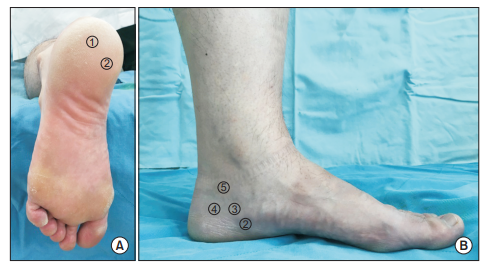 압통을 톤한 족저근막염 진단