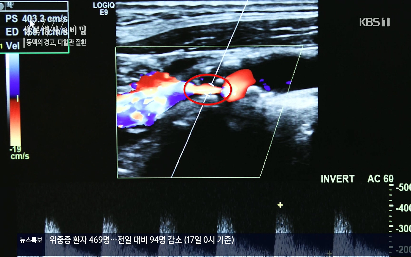 생로병사의 비밀.E831.220817p.H264-F1RST.mp4_20220822_185314.436.jpg