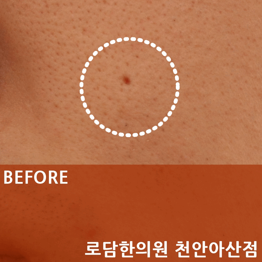  모공흉터 파인자국 치료과정 새살침 코라테라피