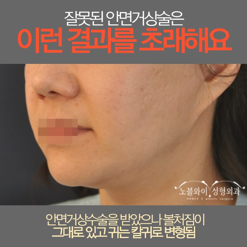  안면거상술재수술 안할수가 없는 상태