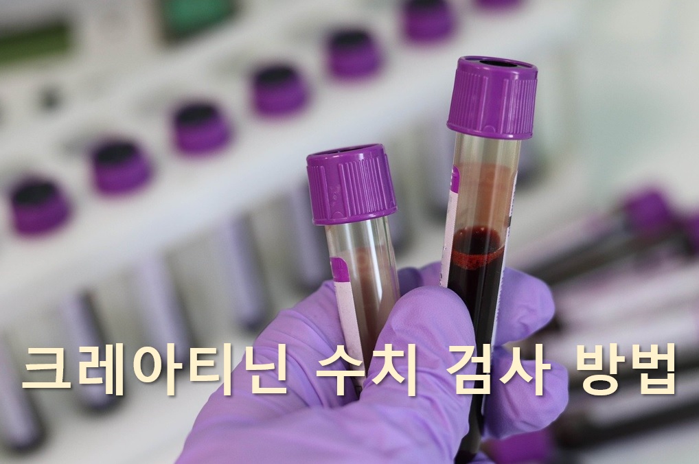  신장 배설 기능을 평가하기 위한 크레아티닌 수치 검사 방법