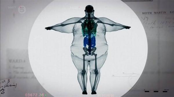  체중 400kg남자의 엑스레이 사진