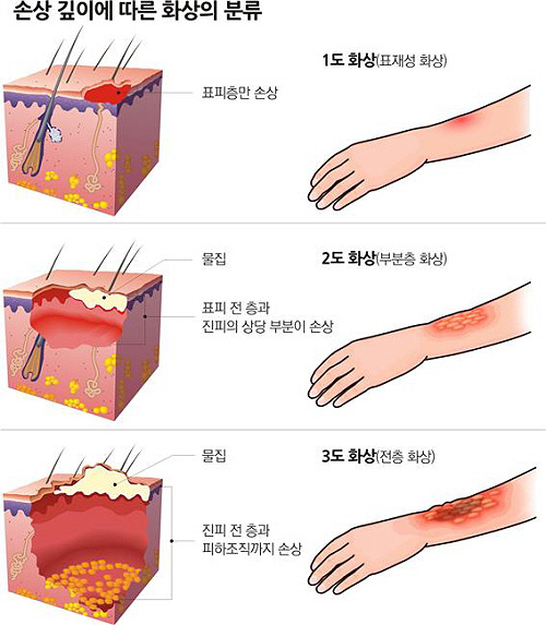 화상단계