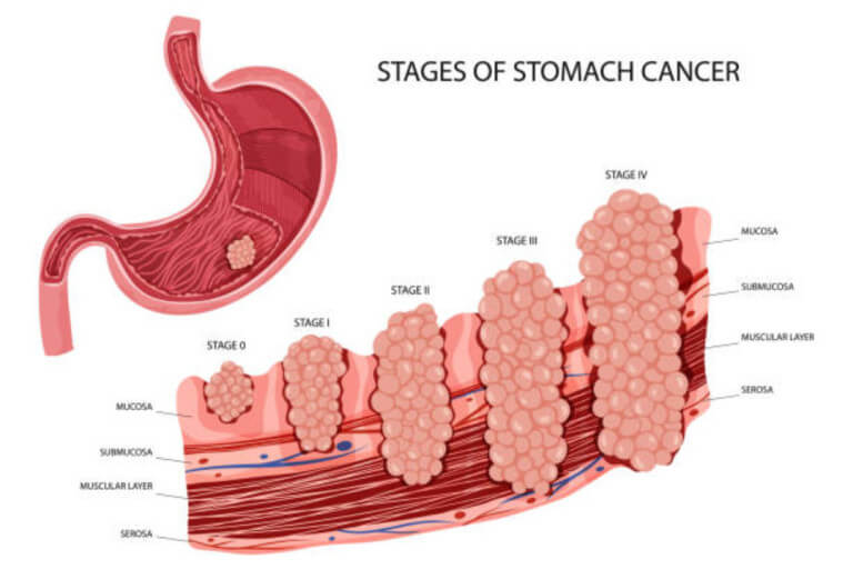 위암의 진행경과