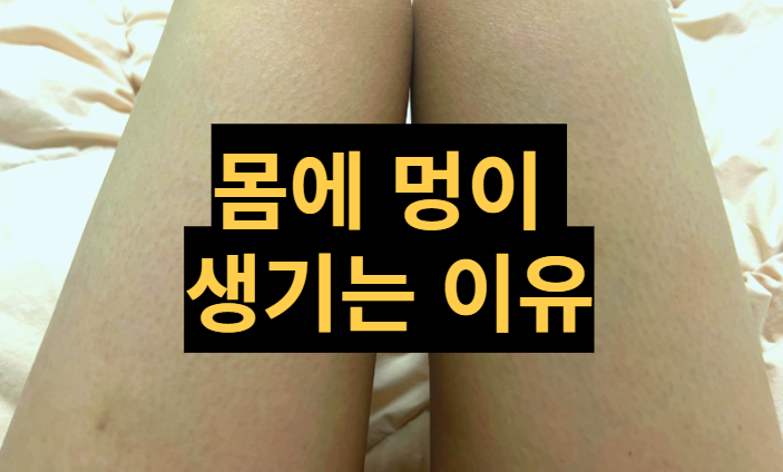  [건강정보] 몸에 멍이 생기는 이유 무엇 때문일까?