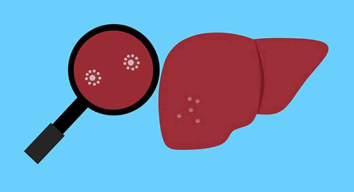 5년 안에 사망하는 간암...누가 왜 걸리나 ㅣ C형 간염 치료 후 암 추적 절차 크게 간소화 Researchers develop new stratification tool for liver cancer ri