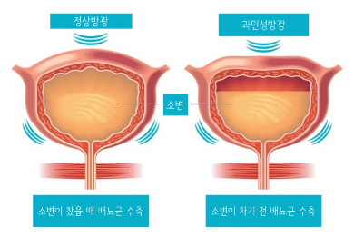과민성 방광의 치료방법과 베타미가의 효과와 가격 2