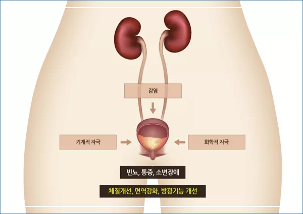 방광염