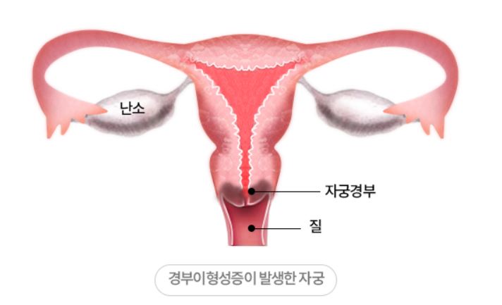 자궁경부이형성증이-발생한-자궁