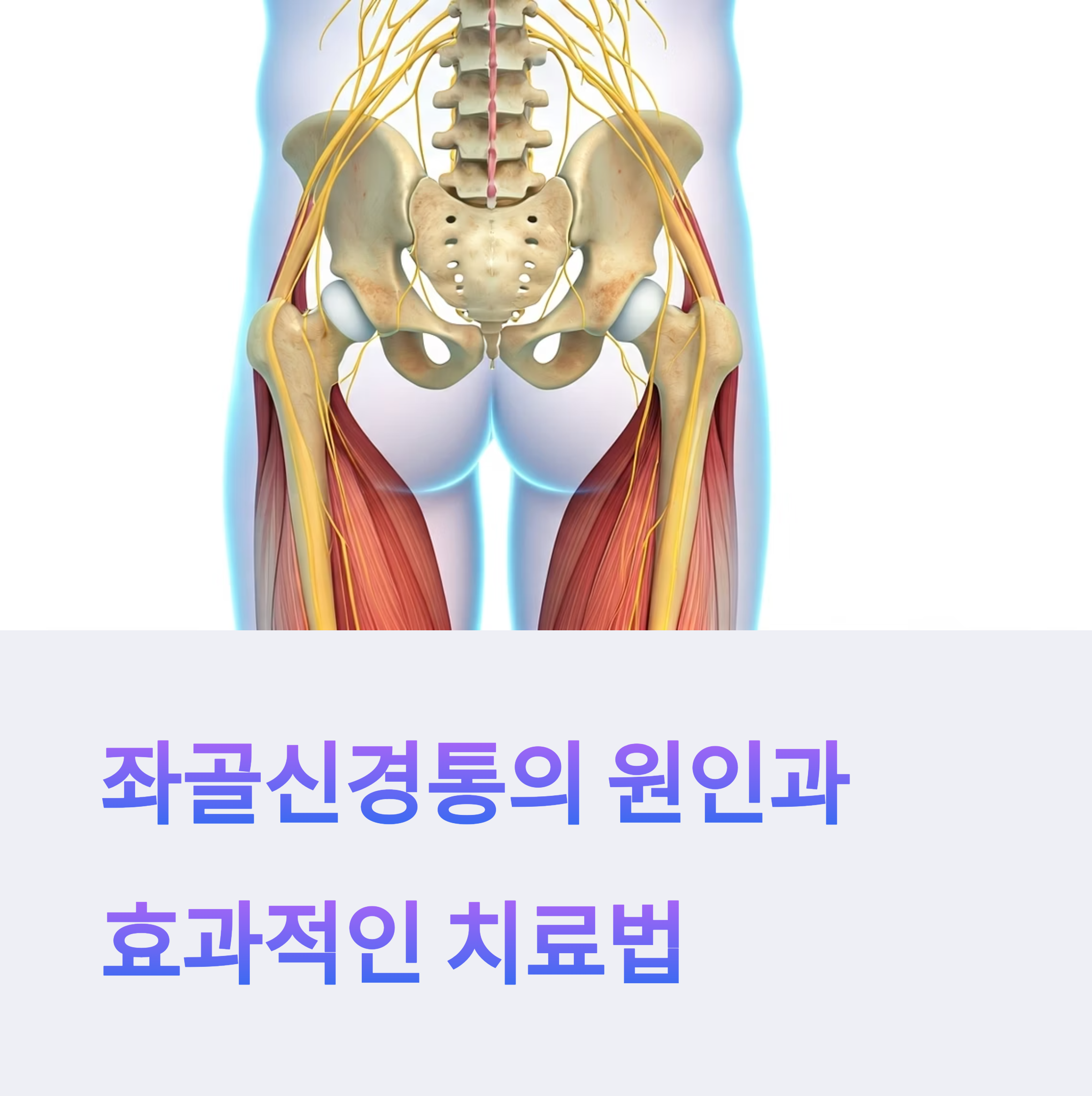엉덩이부터 다리까지 이어지는 심한 통증