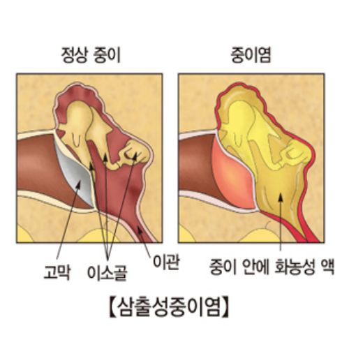  귀에 물찬느낌 중이염 증상 의심해 봐야