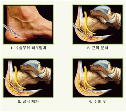 족저근막염 치료-수술