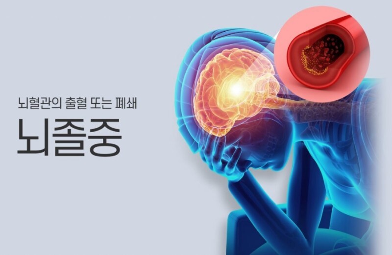  뇌졸중 전조증상 11가지 및 예방하는 방법
