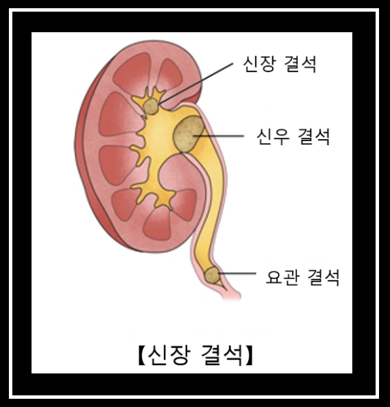  신장결석 증상 확실히 알고 그 예방법!