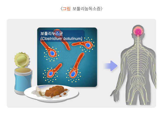 보툴리눔독소증