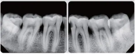 충치있는 아래 좌우측 어금니의 치근단영상