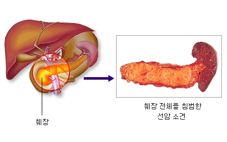 췌장암-초기-증상-원인-주요-검사-방법-치료-등-허리-복통-소화불량-생존율