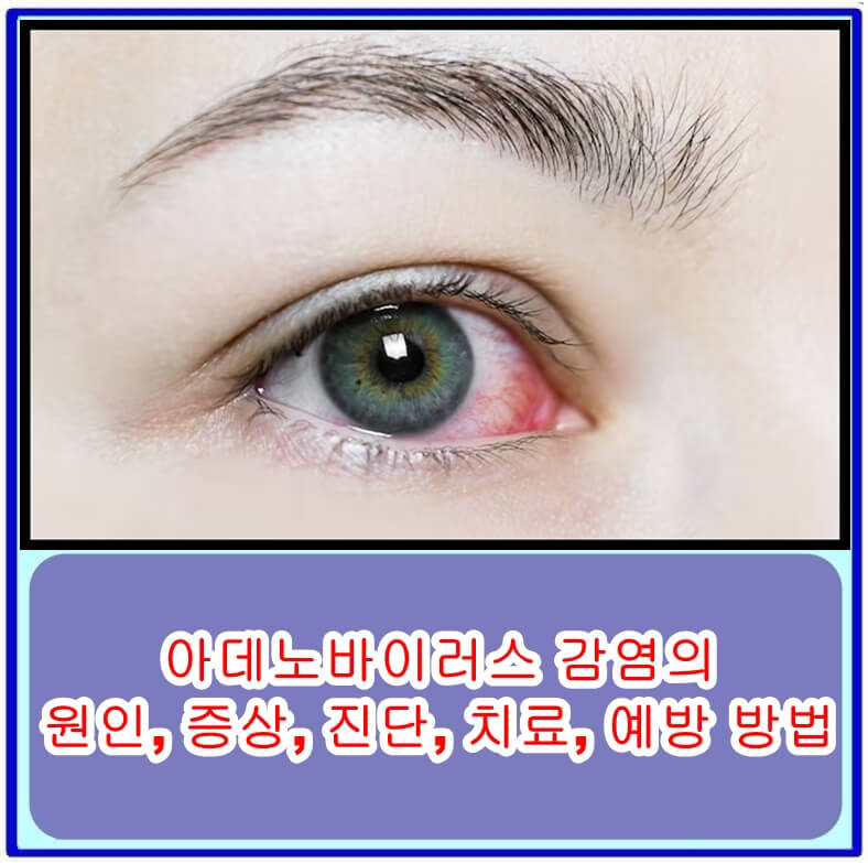  아데노바이러스 감염의 원인, 증상, 진단, 치료, 예방 방법