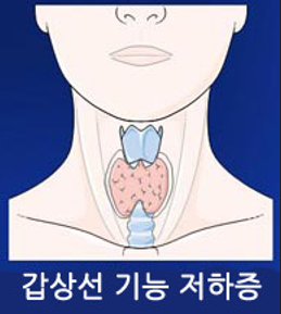 갑상선기능저하증