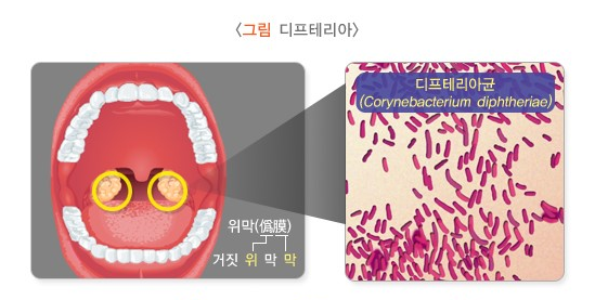  디프테리아균