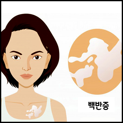  백반증 초기증상 원인 치료방법