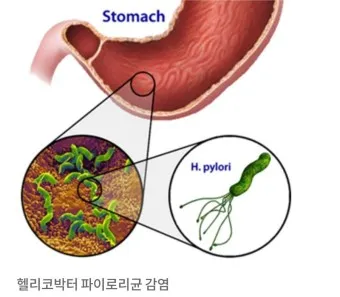 헬리코박터균 제균 치료 치료방법 성공률_16