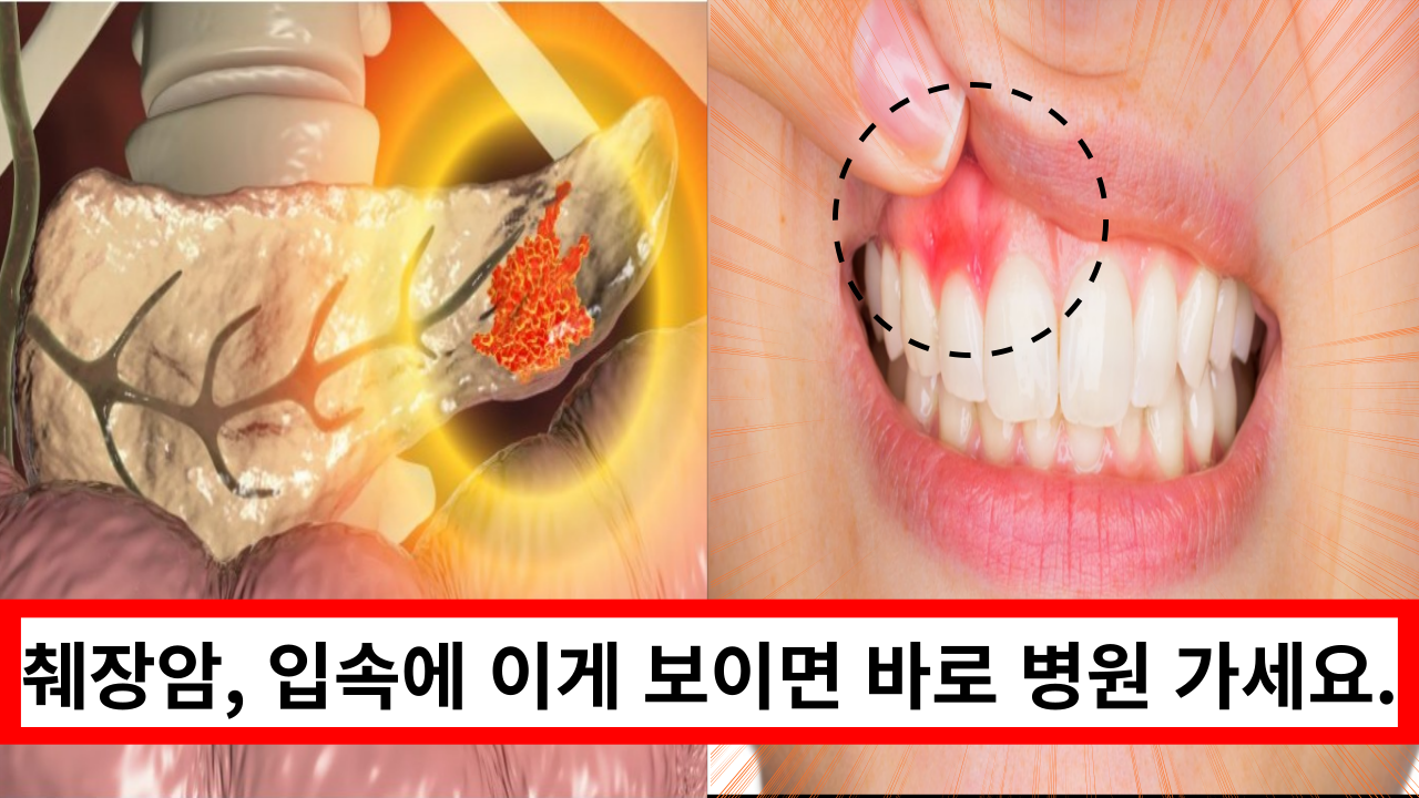  '아무도 몰랐던 췌장암 증상' 입속에 이것이 있으면 바로 병원가세요.